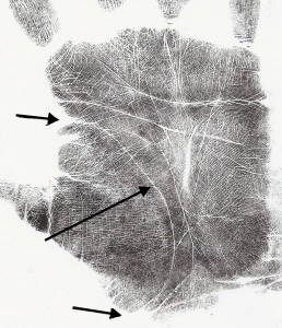 Fig. 1 - Arrows point to a long and curving Life Line.